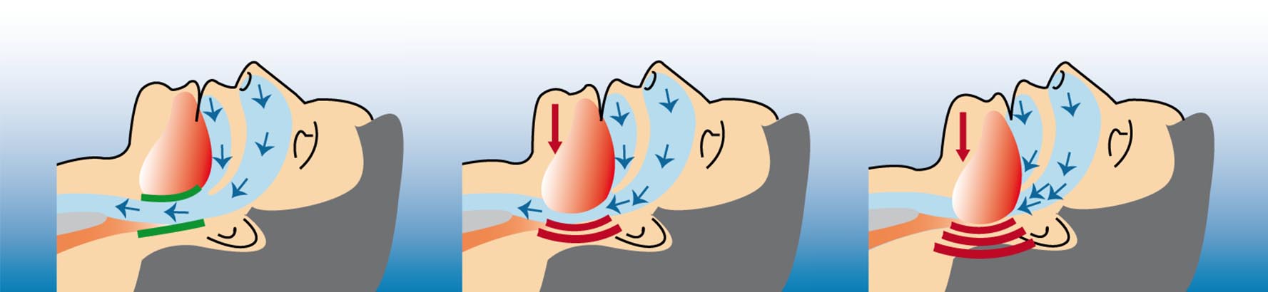 Illustration des Schnarch-Vorgangs