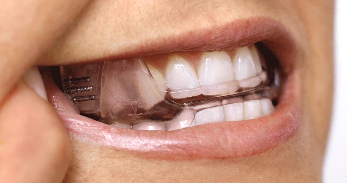 Situation mit SomnoDent Schiene